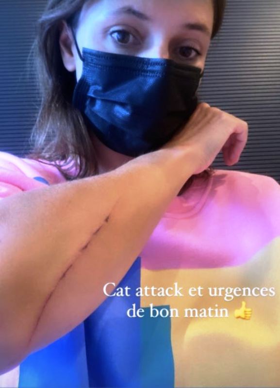 Lolita Séchan showing her scraped forearm with bite marks
